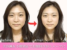 ワト(WATO)/■小顔施術（before→after)