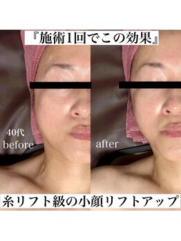 スリーム(S-urimu)の写真/【フォト婚でも写真映えをお約束】華奢な二の腕×フェイスラインくっきり小顔☆マシン10種カスタマイズ☆