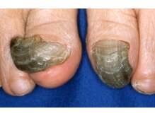 ドクターネイル爪革命 秋津店/厚い爪、変形した爪でお悩みの方