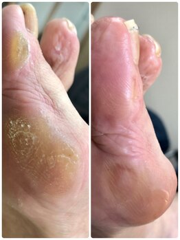 カルカルフット アンド カルネイルサロン(Karu karu foot & Karu nail salon)/角質ケアで足裏快適に♪