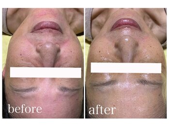 モイ(moi.)/◆Wピーリング◆