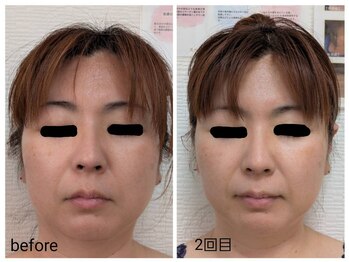 レゾン 京橋店/【Before/after】最新韓国美容★