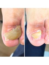 ドクターネイル爪革命 小田原鴨宮店/肥厚爪ケア