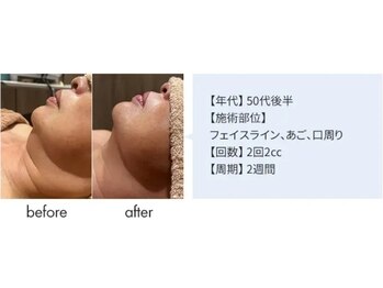 サロン ド ルポス/レモンボトル×小顔フェイシャル