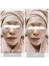 エメ(Aimer)/【40代レモンダーマ結果写真☆】