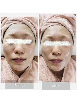 エメ(Aimer)/【40代レモンダーマ結果写真☆】