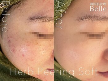 【毛穴|ハーブピーリング】韓国肌管理Belle 天文館/ハーブピーリング|ニキビケア