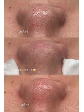 レア(Lea)/毛穴洗浄のbefore→after.