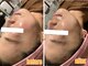 ジョイアビューティー(Gioia beauty)の写真/【韓国大人気の小顔ケア★】二重顎の脂肪分解ならレモンボトル!小顔+水光肌も目指すならレッドショット◎