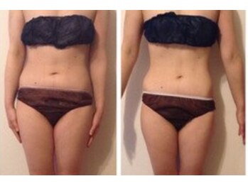 ルナ ボーテ(Lune Beaute)/上半身オーダーメイド6回