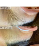 アロー(Allo!)/うなじ毛の変化