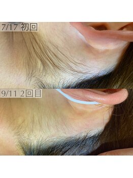 アロー(Allo!)/うなじ毛の変化