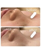 ニコリ(nicori)/【毛穴ケア】beforeとafter