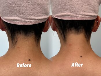 クイーン 渋谷店(QUEEN)/うなじはセットでお得