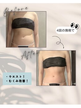 リンガ(Ringa)/ビフォーアフター【腸活ケア】