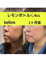  Ｌ’ｌａ　ｃｉｔｔａ【パーソナルカラー/毛穴洗浄/まつげパーマ/ヘッドスパ】/レモンボトル4cc