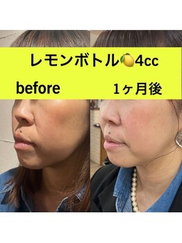 L’la citta【パーソナルカラー/毛穴洗浄/まつげパーマ/ヘッドスパ】/レモンボトル4cc