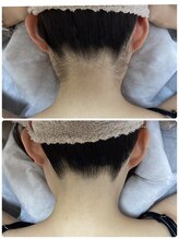 ルルトウキョウ 池袋店(LULU.tokyo)/うなじ脱毛