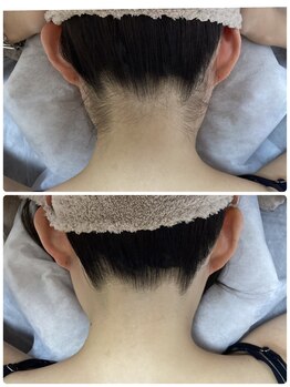 ルルトウキョウ 池袋店(LULU.tokyo)/うなじ脱毛