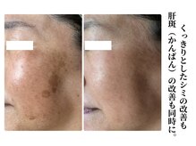 ボータン 恵(Beau Temps)の雰囲気（複数の種類のシミ改善を同時に。）