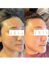 チェイル(JEIL)/剥けないハーブピーリング