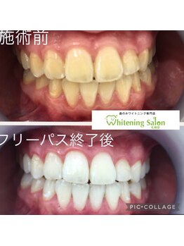 ホワイトニングサロン 札幌店/【ホワイトニング施術例】#札幌