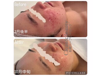 クリーンアンドビューティ 札幌(Clean&Beauty)/ダウンタイムをとって肌改善!