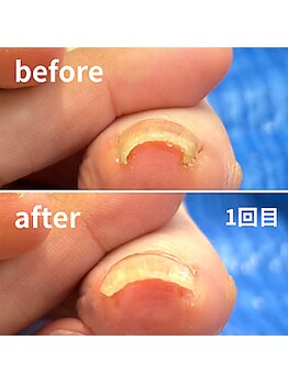 とくしま整体院 藍住院/巻き爪ビフォーアフターです！