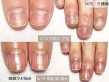 エヌプラス(Nplus)の雰囲気（噛癖がお悩みでしたが、こんなにキレイに伸びました♪）