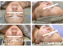 マッチ(much)/小顔人気１位　脂肪分解術　