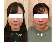 サロンベイビー 西宮本店(Salon Baby)/【BeforeAfter】小顔美容整顔