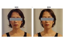 クレネ(Clene)/施術後の変化