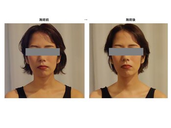 クレネ(Clene)/施術後の変化