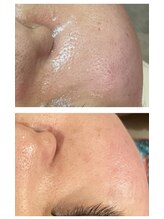 シャムリー 並木坂(Syamry)/高濃度CICAとハーブピーリング