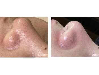 ハナ トータル ケア(Hana Total Care)の写真/≪初回9,800円≫大人気角質ケア+水玉リフティング★プラピール＆ララピールもおすすめ【ニキビケア/毛穴】