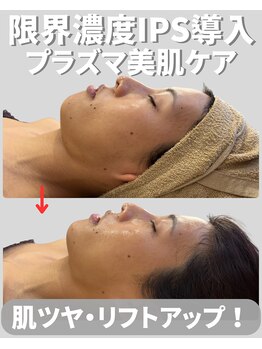 アディス 心斎橋(ADISE)/限界濃度IPS導入プラズマ美肌