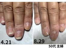 カンナ(Kanna)/「ジェルで剥離した爪の改善」