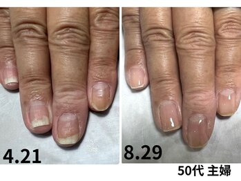 カンナ(Kanna)/「ジェルで剥離した爪の改善」