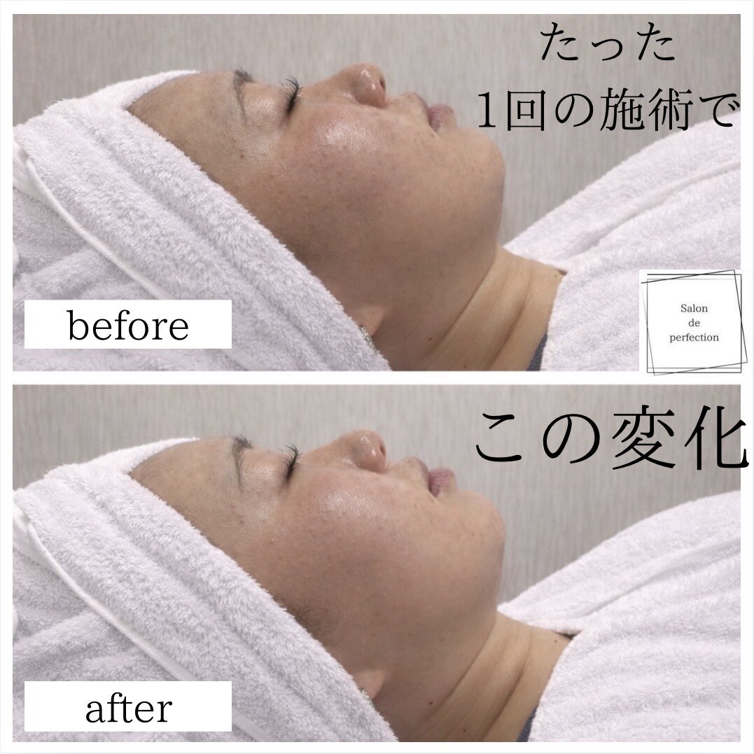  予約殺到!!【お試し/即効実感】最新機器★小顔リフト30分\12100→ 
