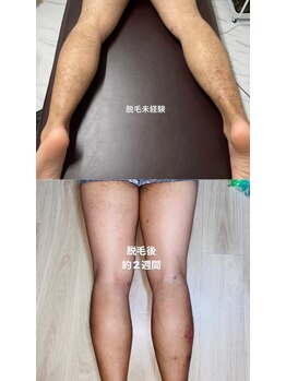 ヴィル(vil)/メンズ脚脱毛１回効果