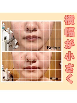 オプレア 千種店(OPREA)/小顔コルギで即日スッキリ！