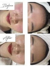 ビズビズ 梅田店(bisebise)/〈症例〉赤ら顔改善