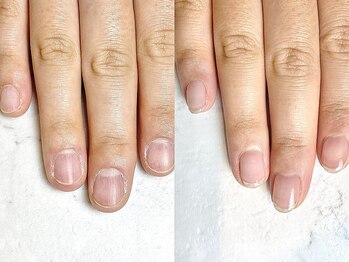 レヴィア(Revia)/深爪ケア 経過