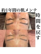 サロンツキ(salon tuki)/ハーブピーリング症例/徳島