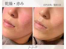 スリースリー(THREE THREE)/乾燥・赤みケア