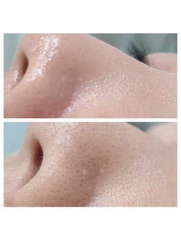 リンド(Lindo)/ハイドロ毛穴フェイシャル