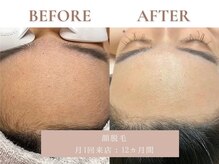 サエラ(SAERA)/顔脱毛【12回】