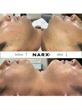 ナークス(NARX)/【ヒゲ脱毛】ビフォーアフター