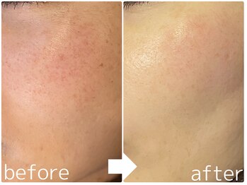 ラピュール(RaPur)/ホワイトニングケア