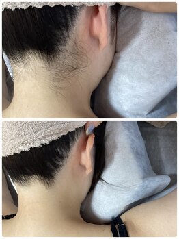 ルルトウキョウ 池袋店(LULU.tokyo)/うなじ脱毛